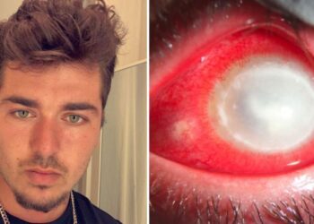 ‘Parasitas carnívoros comeram meu olho’: jovem perde visão após dormir usando lentes de contato
