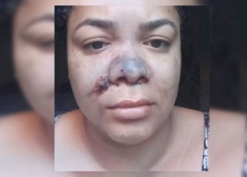 Paciente perde parte do nariz após procedimento estético