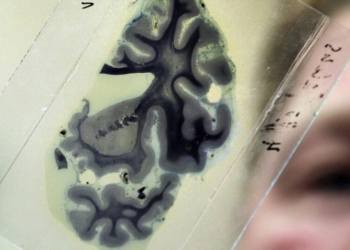 O fim do Alzheimer? Pesquisa promissora usa ultrassom para eliminar a doença