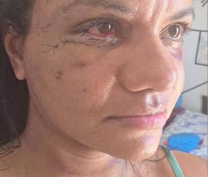 Mulher espancada com mais de 60 socos mostra rosto após cirurgia para reconstrução facial