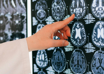 Pesquisadores criam modelo 3D que revela evolução de metástase cerebral em tempo real