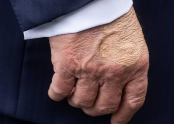 Casa Branca culpa excesso de apertos de mão por curativos de Trump